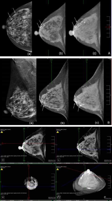 cone shaped tits|Conical Breasts Overview: What to Know